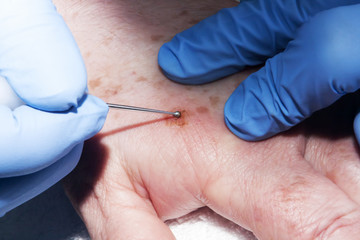 Microsurgery : Dermatologist surgeon removes skin diseases