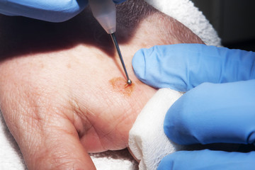 Micro surgery : Close up hands of dermatologist surgeon removing skin diseases using electroagulator
