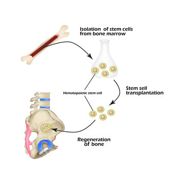 Stem cells from bone marrow are used for bone regeneration. Infographics. Vector illustration