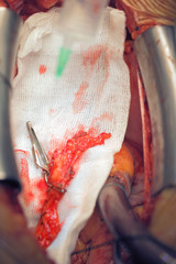 Modern surgery. Coronary artery bypass grafting. Step of operati