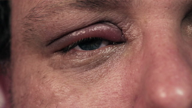 Man treating infected eye