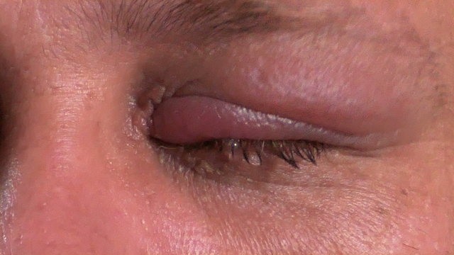 Man treating infected eye, 4K