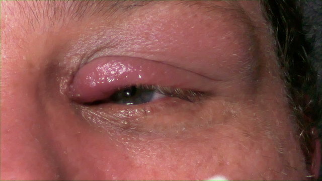 Man treating infected eye, 4K