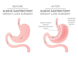 Stomach Staple Bariatric Surgery Resulting in 1/4 of the Stomach Removed.