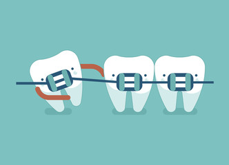Braces teeth of dental healthcare ,dental concept
