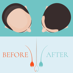 Top view of a man before and after hair treatment and hair transplantation. Implantation of hair. Hair care concept. Hair bulb logo. Hair loss clinic concept design. Isolated vector illustration.