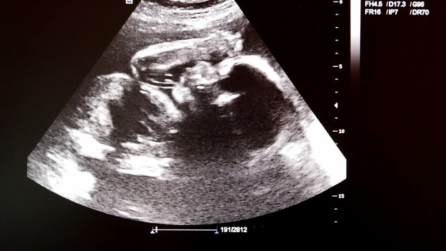 Video of monitor with ultrasound of a baby at 21 weeks