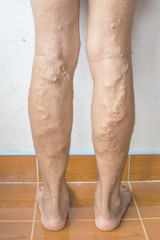isolated irregular varicose veins on woman leg