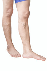 isolated irregular varicose veins on woman leg
