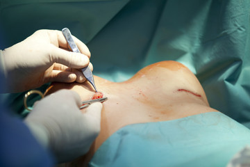 breast augmentation surgery in the operating room surgeon tools implant