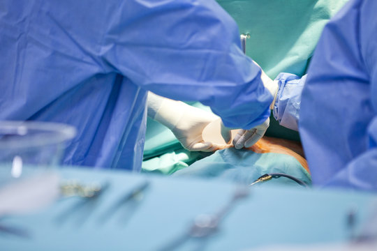 breast augmentation surgery in the operating room surgeon tools implant