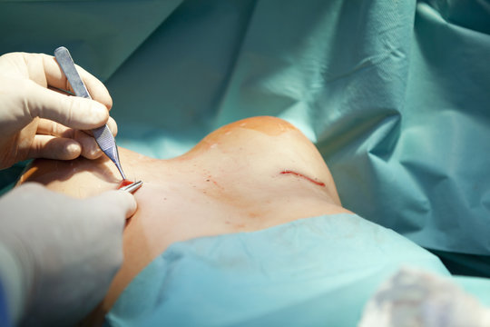 breast augmentation surgery in the operating room surgeon tools implant