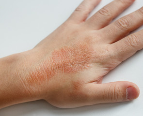 Red spots on child hands skin covered with moisture cream. The cause is winter cold and wind...