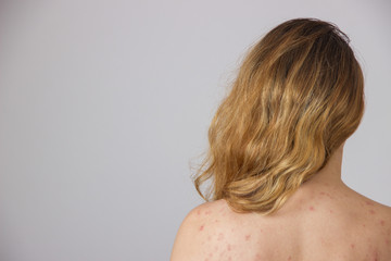 Young girl with acne, with red and white spots on the back