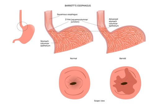 Barrett's esophagus: inflamed and injured portion of the esophagus