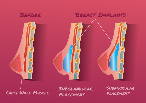 Breast Implant vector illustration infographic