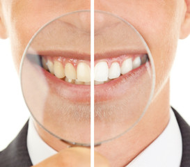 Smiling man with magnifying glass zooming on his smile, teeth: before and after concept