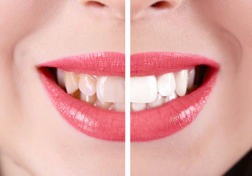 Smiling woman, teeth: before and after concept