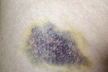 Blue bruise on skin