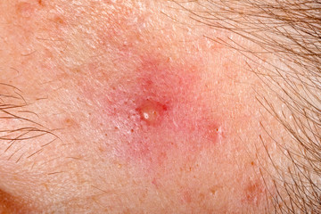 Fototapeta premium Nodular cystic acne skin
