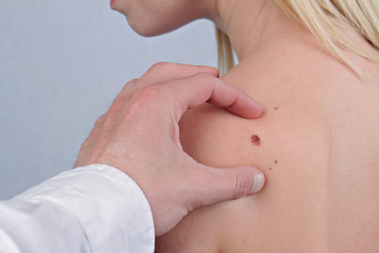 Doctor dermatologist examines  birthmark of patient close up. Checking benign moles