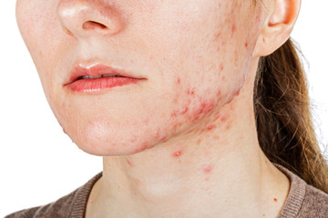  Young girl with skin problem