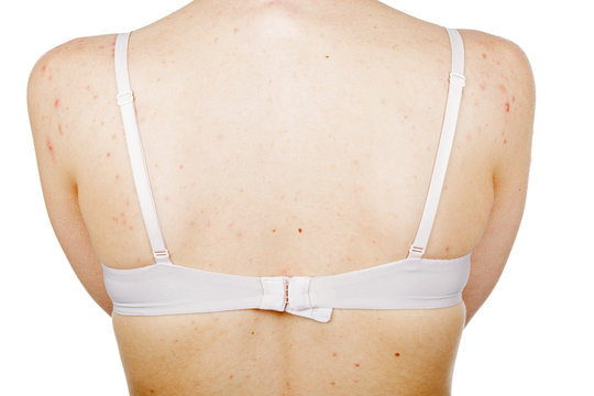Acne skin on female back