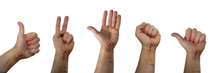 isolated views of the hand with fresh scar