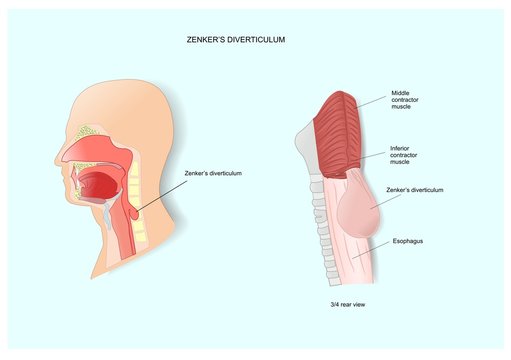 esophagus disease, the Zenker's diverticulum