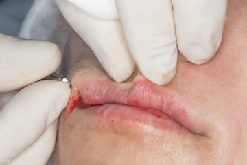 Photo of cosmetic procedures .