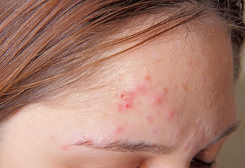 Acne on the girl's forehead