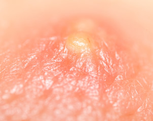 pimple on the skin. macro