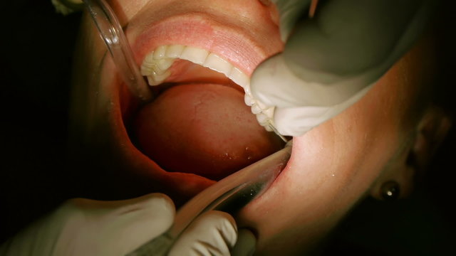 Polishing Height Adjustment on Dental Inlays With Audio