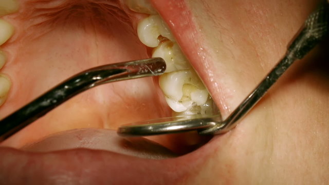 Dentist Checking Molars after drilling deep for cavities