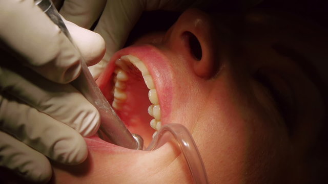 Height Adjustment On Dental Implanted Inlays