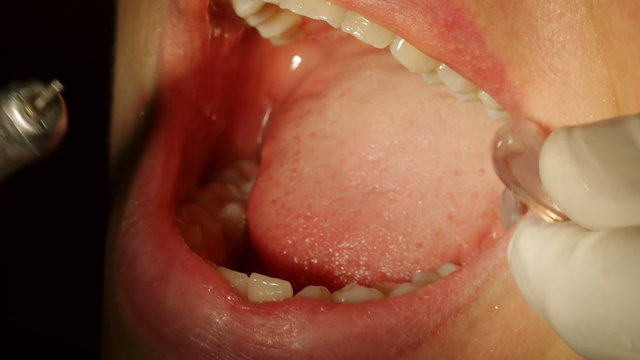 Dental Drilling Work On Female Mouth