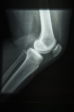 x-ray image of a knee
