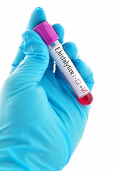 Fototapeta premium Blood sample positive with Entamoeba histolytica (E.histolytica) antibody 