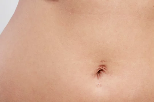 Belly clearance ring scars