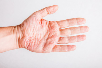 eczema atopic dermatitis symptom skin texture
