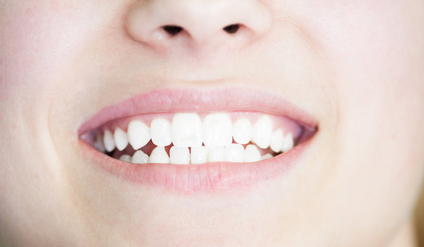 Young white smile after bleaching