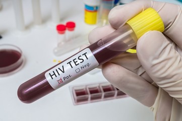 Hand holds test tube for HIV test. - obrazy, fototapety, plakaty