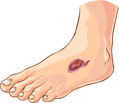  Vector Illustration Of A Medical Diabetic Foot