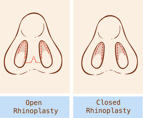 Vector illustration of a anatomy Rhinoplasty technique