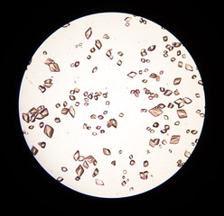 uric acid crystal in urine.