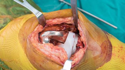 arthroplasty