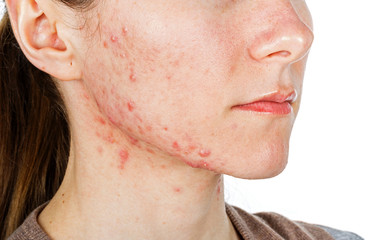  Young girl with skin problem