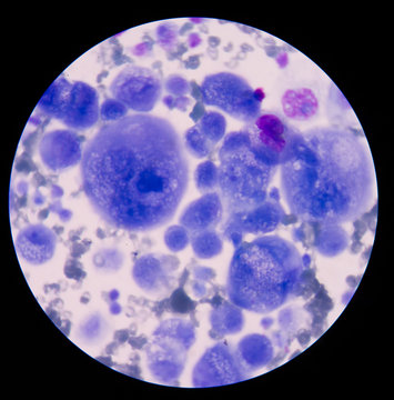 mesothelial cells in body fluid.