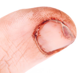 Finger cut with sharp knife