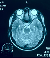 Real brain MRI slide of a young woman. Patient's and clinic's na